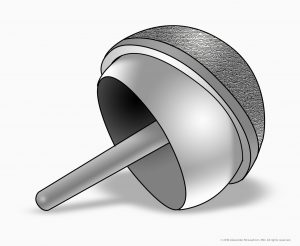 illustration of hip resurfacing metal ball joint