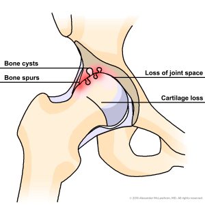 illustration of hip bone with arthritis, labeled with cysts, spurs, and empty space where cartilage would be