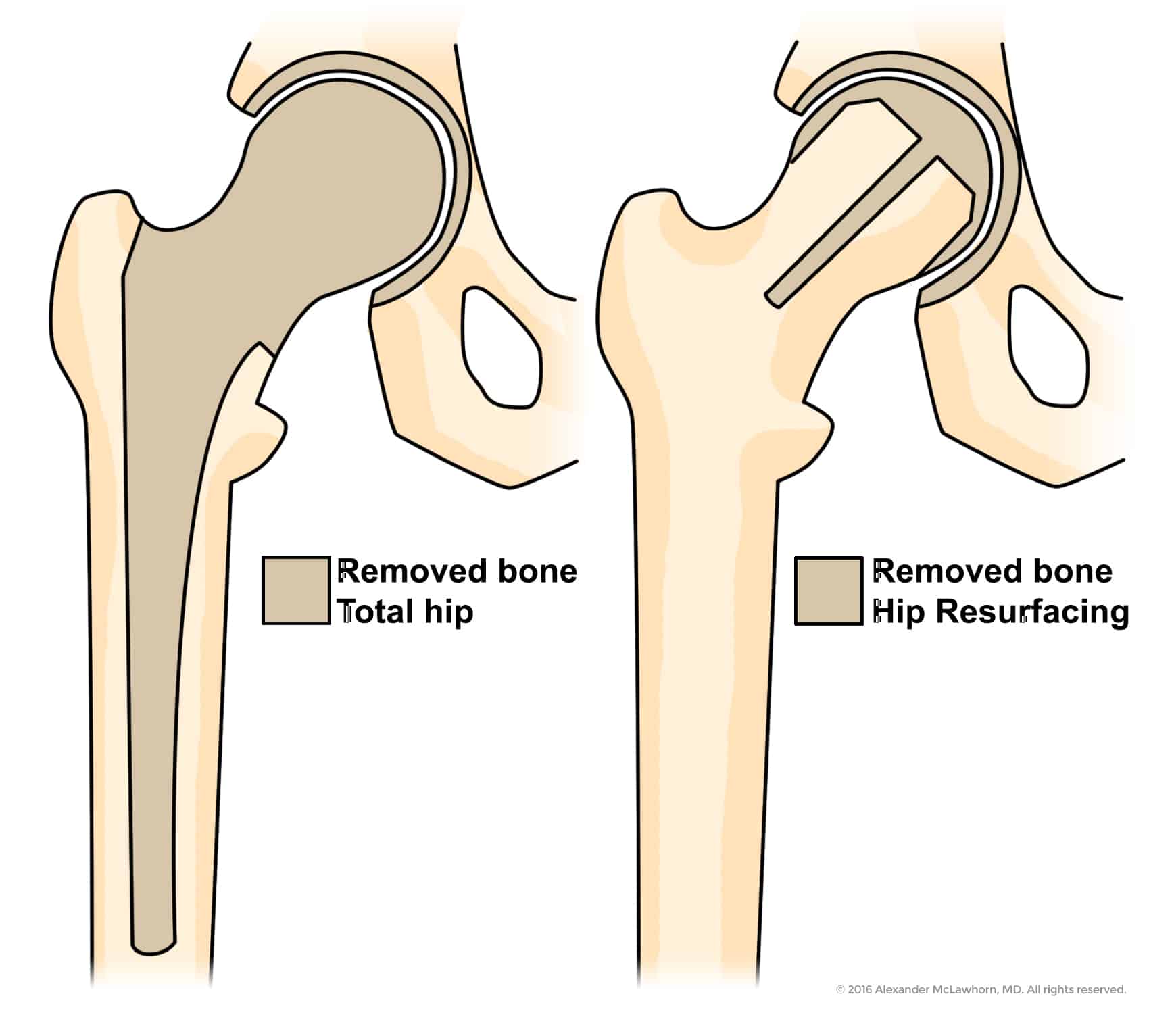 illustration of hip bone during total hip replacement versus hip resurfacing, much more of bone remains after resurfacing