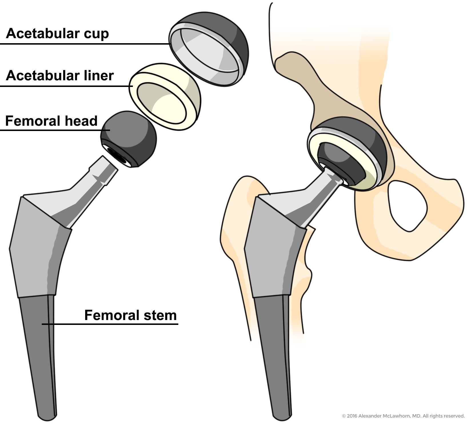 illustration of metal hip replacement parts, including femoral stem and head, as well as same metal replacement inserted into pelvic bone