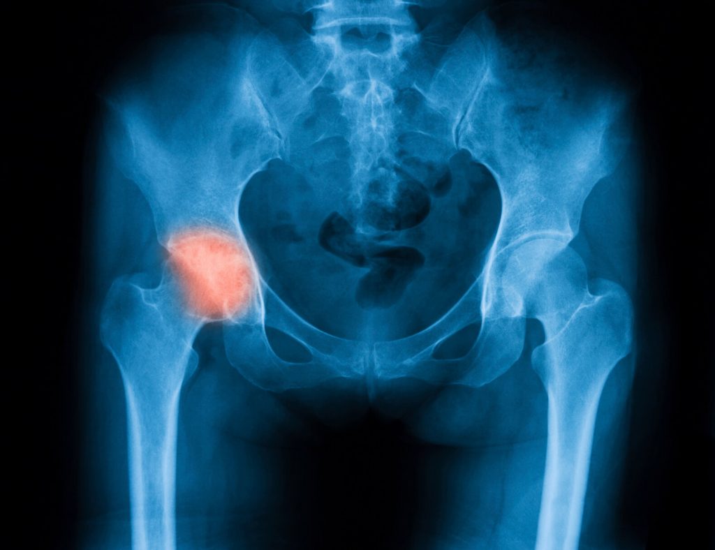 Hip in need of joint replacement