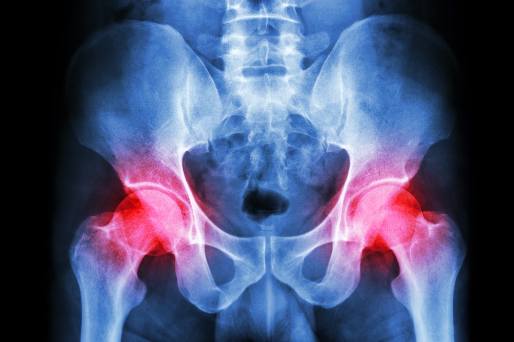 film x ray human's pelvis and arthritis at both hip joint (Gout , Rheumatoid)
