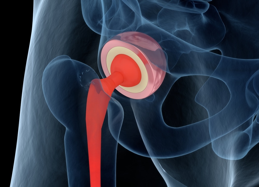 Medical illustration showing a hip joint with a prosthetic implant, highlighting the artificial ball-and-socket components